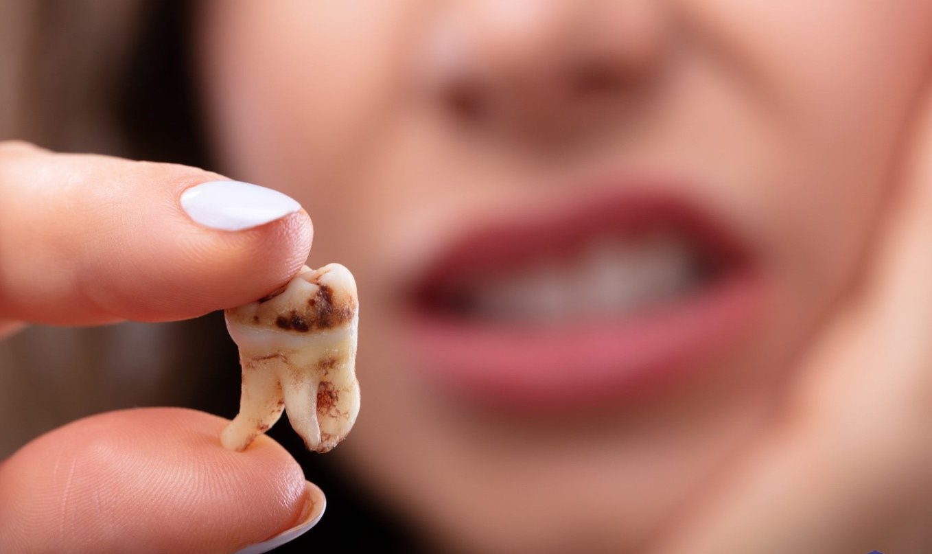 مهمترین عامل جلوگیری از پوسیدگی دندان
