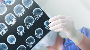 نشانه‌های ساده علائم اولیه حمله ام اس 