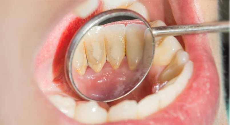 این خوراکی‌ها دندان‌های شما را زرد می‌کنند/ ۱۰ماده غذایی که سبب تغییر رنگ دندان می‌شوند